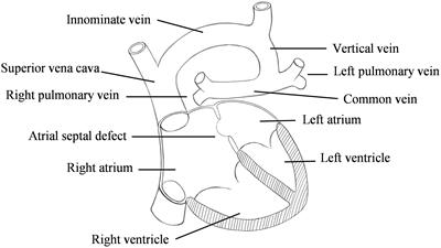 Numerical Simulation of Hemodynamics in Two Models for Total Anomalous Pulmonary Venous Connection Surgery